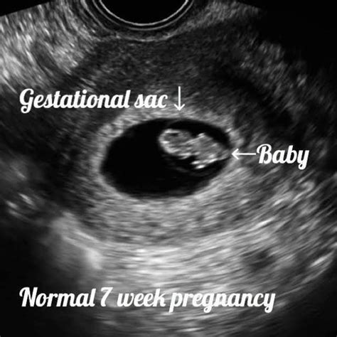 Molar Pregnancy Information Ultrasound Included Ultrasoundfeminsider