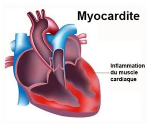 Symptoms of the condition can last from several hours to months. 81 Myocardite - Opéré à coeur ouvert.