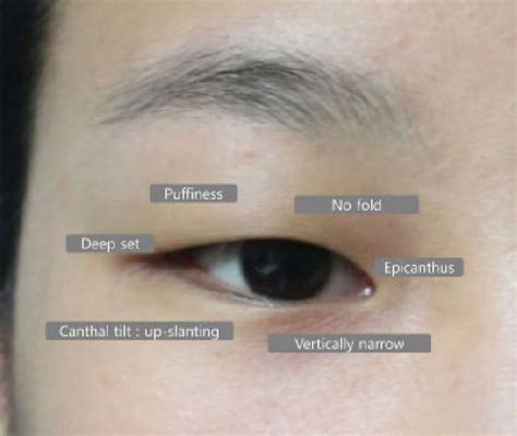 Characteristics Of The Asian Eyelid Puffiness No Fold Deep Set