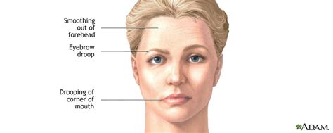 Bell's palsy is a condition that causes partial or complete weakness of one side of the face. Symptoms and Treatment for Facial Nerve Damage - ENT ...