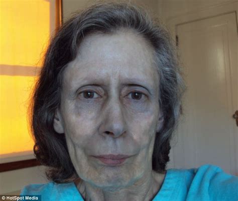 Woman Suffers Argyria For 60 Years After Silver Built Up In Her Body