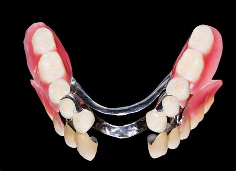 How much do dentures cost? How Much Do Dentures Cost In The UK?