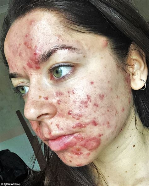 Personal Trainer Shares Her Striking Before And After Acne Pictures
