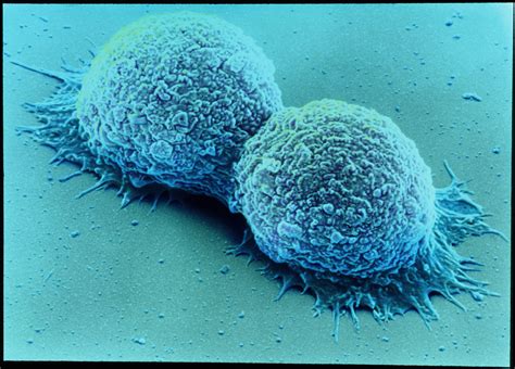 Coloured Sem Of Breast Cancer Cells Dividing Oxford University Innovation