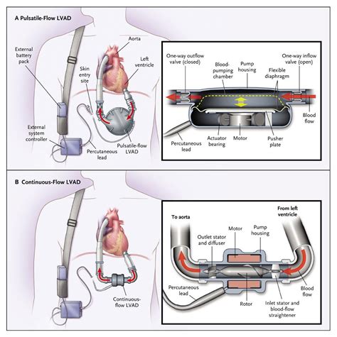 The Abcs Of Lvads For Pharmacists — Tldr Pharmacy