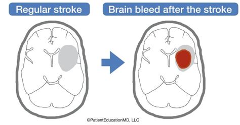 Brain Bleed After A Stroke Patienteducationmd