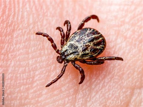 Lyme Disease Infected Tick Insect Crawling On Skin Encephalitis Virus