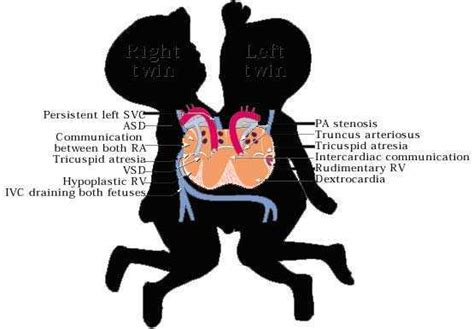 📃 Twins Conjoined Thoraco Omphalopagus