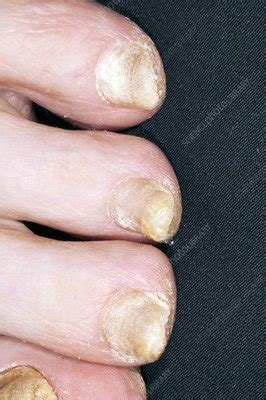 Fungal Infection Of The Toenails Stock Image C Science