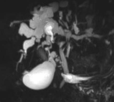 Mrcp In A Cs Patient Showing Dilatation Of Intrahepatic Bile Ducts