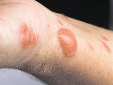 Pyrography is the art of decorating wood or other materials with burn marks resulting from the controlled application of a heated object such as step back and appreciate the hard work you put into it. Safety tips for July 4th: Preventing firework burns
