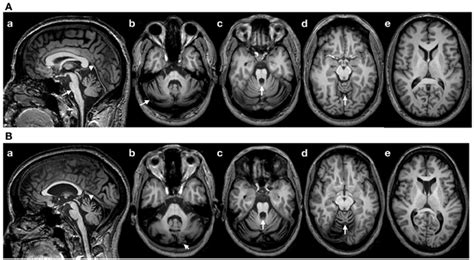 A Brain Mri T1 Weighted Images In Patient 1 A Sagittal Image