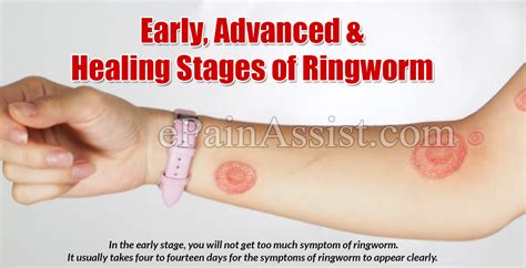 Early Advanced Healing Stages Of Ringworm