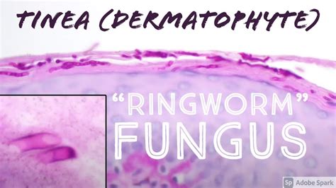 Ringworm Under Microscope Fungus Skin Infection Tineadermatophyte 5 Minute Pathology