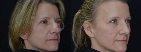 JuvÉderm Voluma Xc Before And After Pictures Case 53 Dallas Tx