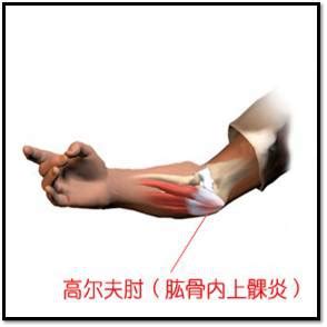 The site owner hides the web page description. 運動傷害防護｜認識羽球運動傷害 - 肘關節篇 - 傳羽運動網