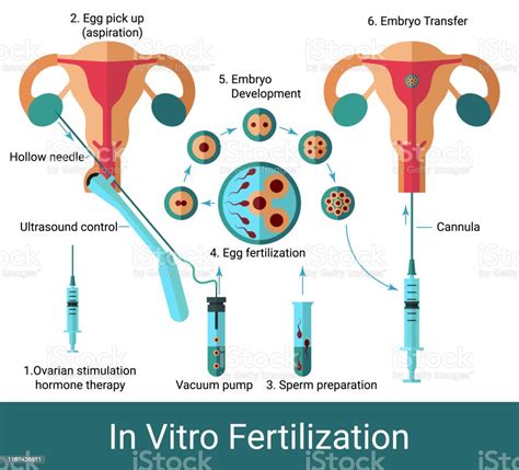 In Vitro Fertilization Infographics Stock Illustration Download Image