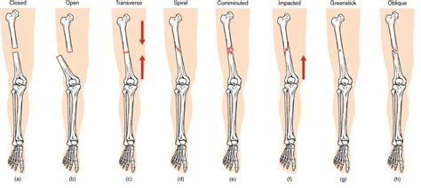 Fractures Bone Repair Anatomy And Physiology I