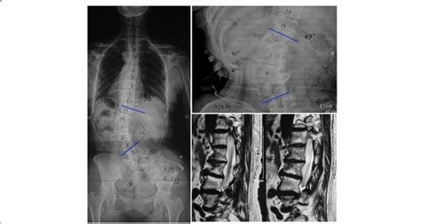 59 Years Old Female Patient With Degenerative Scoliosis Lumbar Cobb