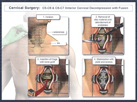 Cervical Surgery C5 6 And C6 7 Anterior Cervical Decompression Wit