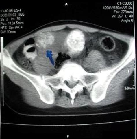 Calcified Ovarian Masses Are Marked In Ct Scan Download Scientific