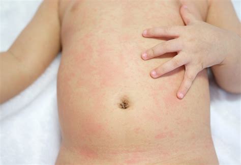 Heat Rash In Infants Reasons Signs And Home Remedies