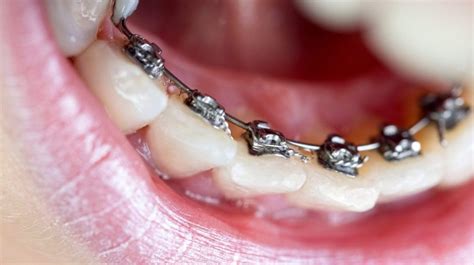 How Do Dentist Put On Braces Some Tips On Dental Braces