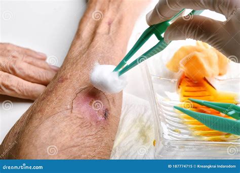 Wound Dressing Doctor Cleaning And Wash Infected Wound In Chronic