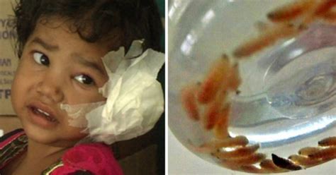 Horror Pics Girl 4 Has 80 Wriggling Maggots Removed From Ear Daily