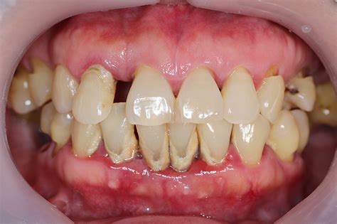 Periodontal Disease Bridgewater Ns What Is Gum Disease