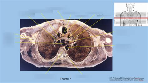 Thorax Cross Section 7 Diagram Quizlet