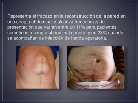 Hernia Ventral Post Incisional