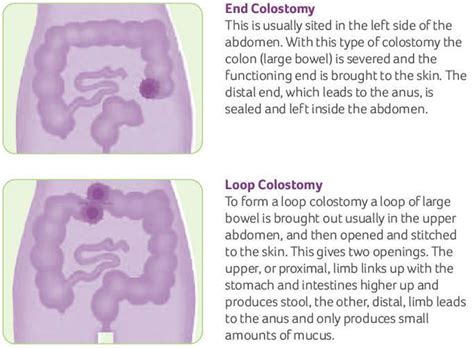 Colostomy How To Change A Colostomy Bag Living With It