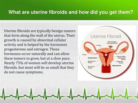 Fibroids In Uterus