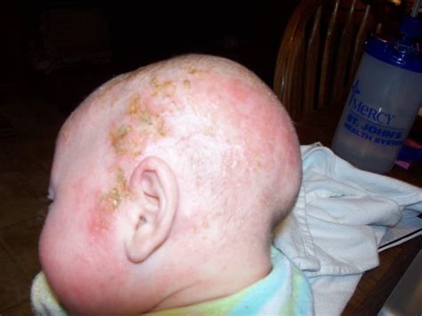 Baby Cradle Cap Pictures Symptoms Causes And Treatments Mommyhood101
