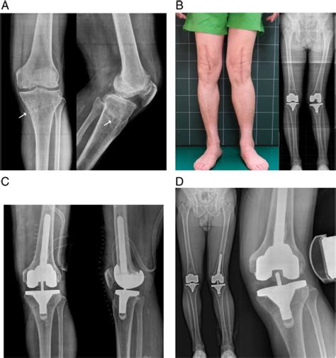 Total Knee Arthroplasty Conversion After Open Wedge High Tibial