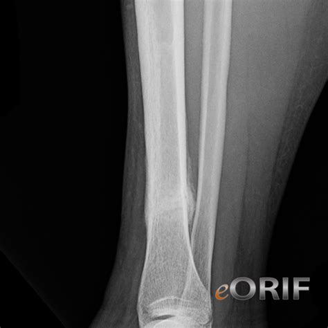 Tibial Shaft Stress Fracture Images Eorif