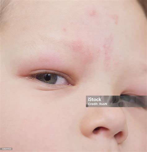 Mosquito Bite On Forehead Swollen Ph