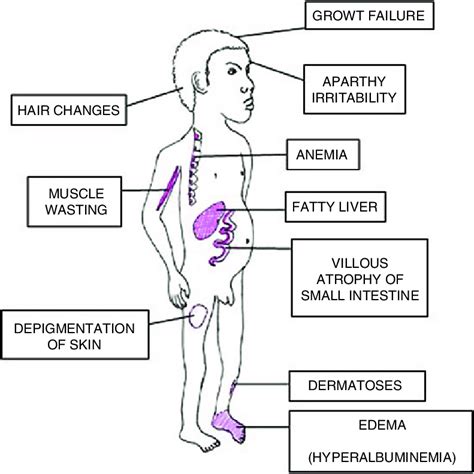 Signs Of Kwashiorkor Drawing By Hallgeir Kismul Download Scientific