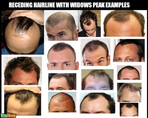 Going bald as you age is a natural phenomenon. What does a receding hairline look like - VisiHow