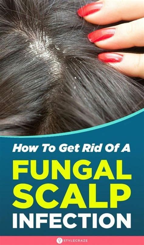 How To Get Rid Of Fungal Scalp Infection 8 Natural Remedies In 2020