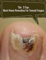Pictures of Holistic Cure For Nail Fungus