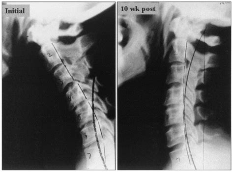 Increasing The Cervical Lordosis With Chiropractic Biophysics Seated