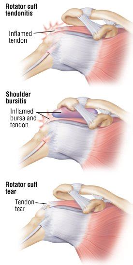 Rotator Cuff Tear Surgery