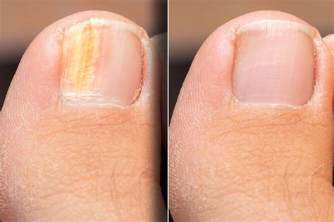 How To Treat Fungal Nail Infection Tinea Unguium Onychomycosis Nail