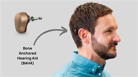 Bone Anchored Hearing Aids Baha Vs Cochlear Implants And Traditional