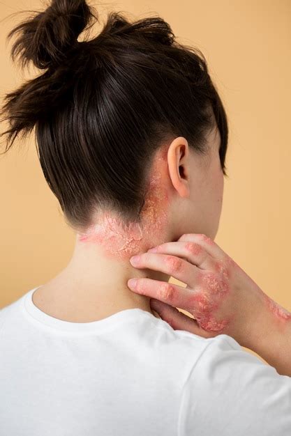 Free Photo Psoriasis Eczema On Neck Of Patient