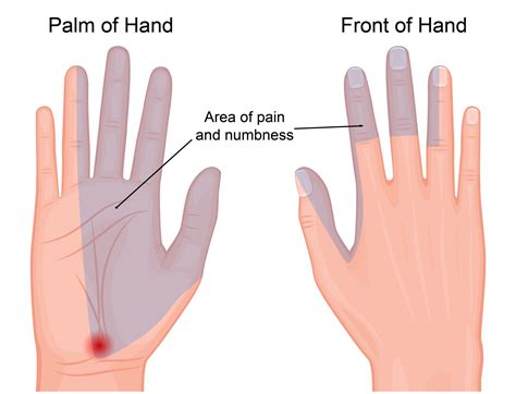 Carpal Tunnel Syndrome Raleigh Hand Surgery — Joseph J Schreiber Md