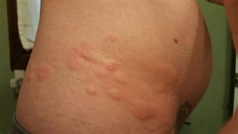 Itchy Rash On Stomach Yeast Infection Rash On Stomach Guide Some