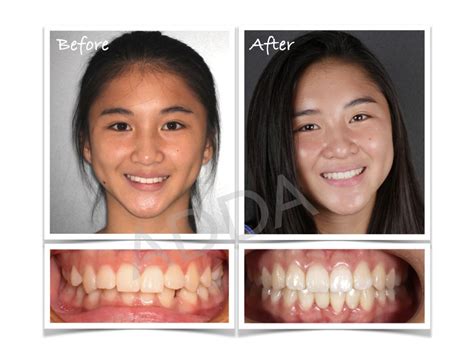Before And After Invisalign Cases